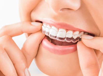 Clear Teeth Aligners Jacksonville FL