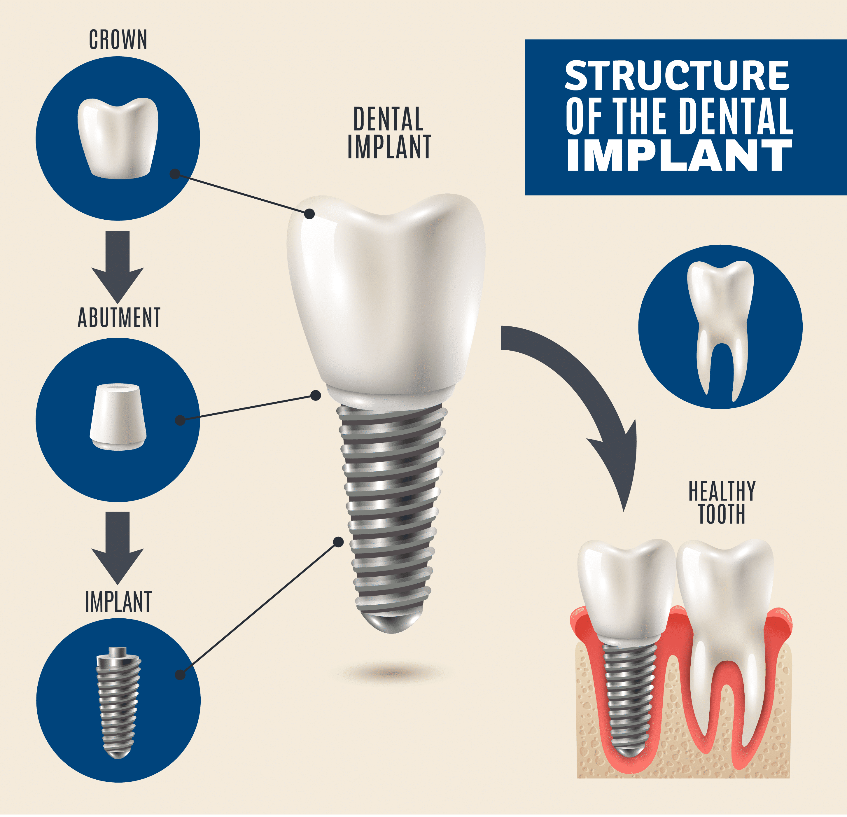 Dental Tooth Implants Jacksonville FL